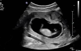 胎动频繁小腹刺痛是临产征兆吗,胎动出现哪些情况需要及时就医