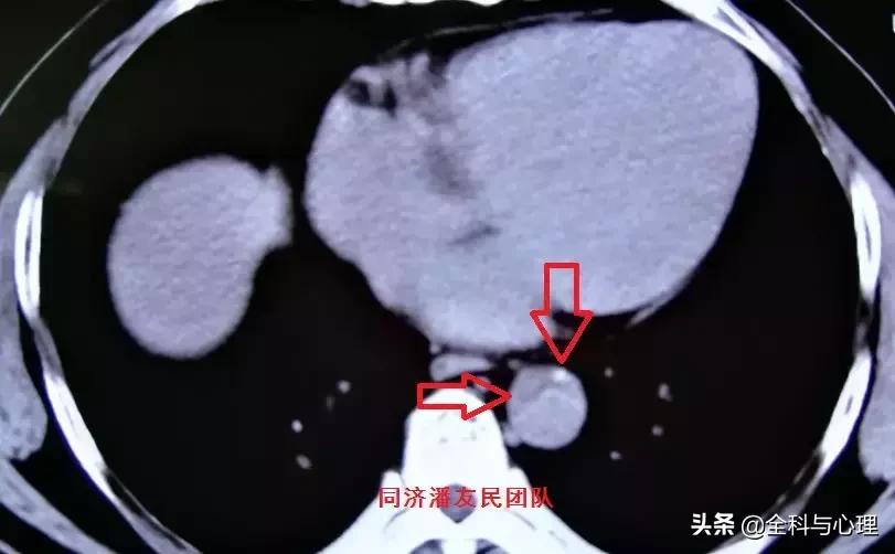 诊断主动脉夹层，千万别犯这种错误！