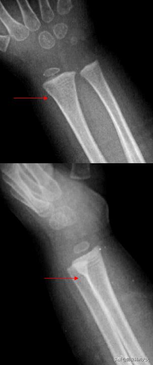 骨折的影像学检查及各自的优势,骨折的影像学愈合标准