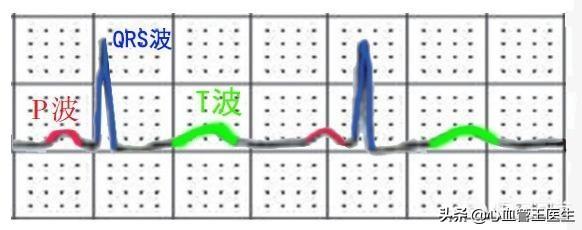 心电图写t波改变心肌缺血严重吗,心电图显示t波倒置