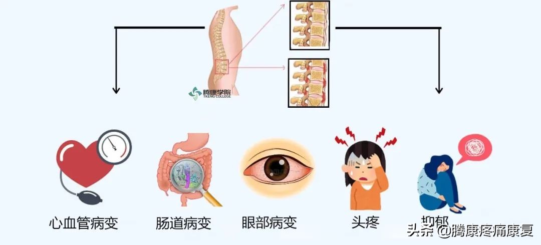 强直性脊柱炎有什么预防的方法吗,强直性脊柱炎预防与锻炼方法