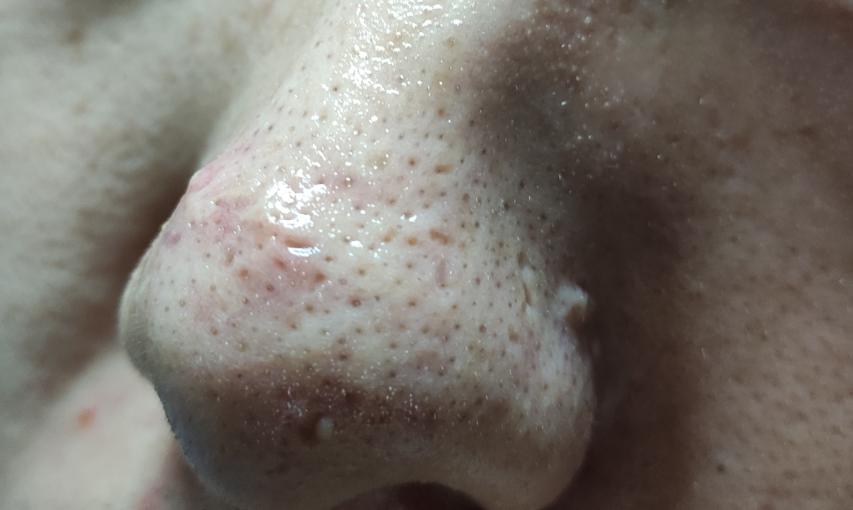 黑头形成的四大元凶,黑头的严重性