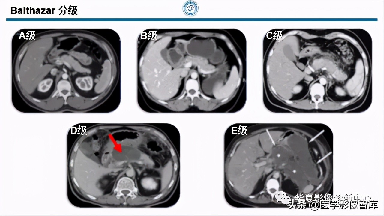 核磁ct都显示急性胰腺炎,急性坏死性胰腺炎的ct表现