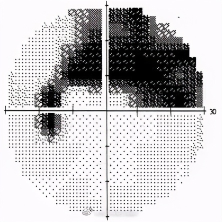 视野不丢，生活无忧|“大夫，我最近看灯光时四周总是有彩虹一样的七彩光晕，有问题吗？”