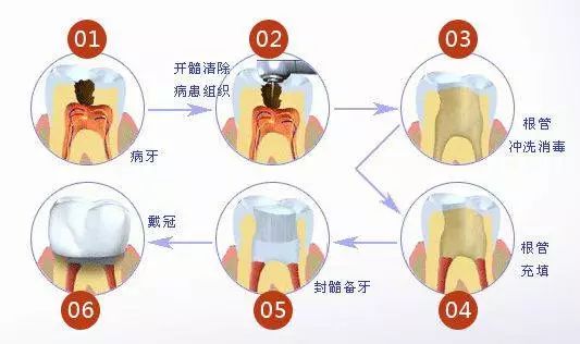 根管治疗后牙齿劈裂怎么办最好,戴冠后牙会不会劈裂
