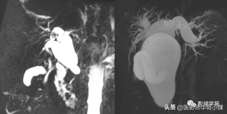 胆总管变异,胆胰管解剖
