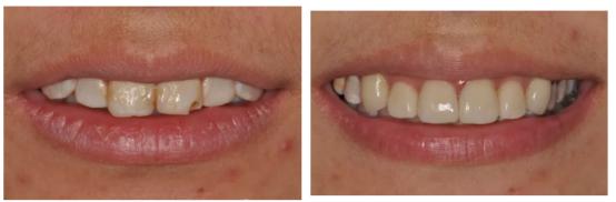 什么方法最适合去黄牙不伤牙齿,一口老黄牙怎么治疗