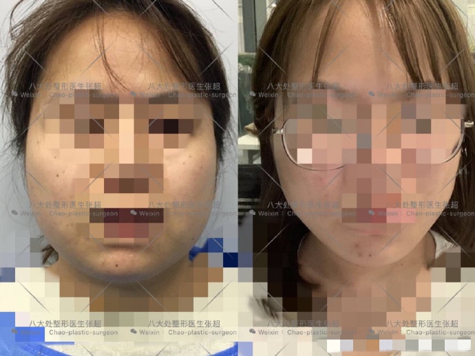 八大处整形张超,八大处张超最新视频