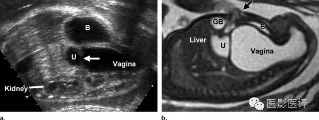 胎儿卵巢囊肿5.6厘米会消失吗,卵巢巨大囊肿与妊娠鉴别