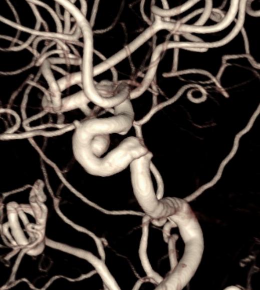 Tubridge®治疗多发性动脉瘤