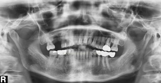 脑血管核磁共振具体检查过程,脑血管核磁共振前要注意什么