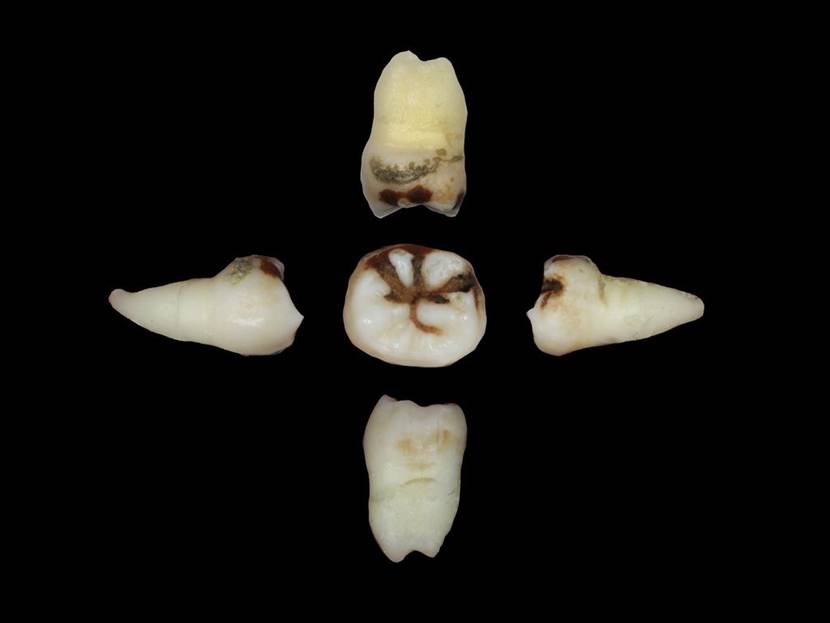 洗牙到底是伤害牙齿还是保护牙齿,洗牙对牙齿伤牙吗