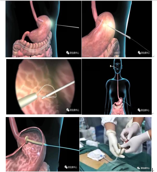 经皮内镜下胃造瘘术操作流程,经皮内镜下胃造瘘术并发症发生率