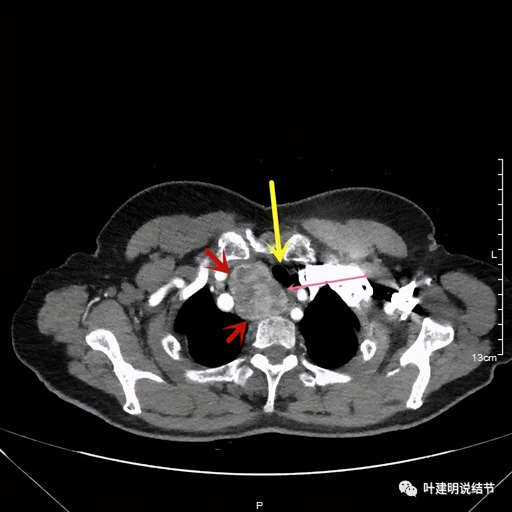 胸部高分辨ct检查注意事项,胸部ct扫描有没有危害