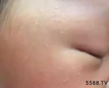 脂肪粒和汗管瘤扁平疣的区别,扁平疣和汗管瘤脂肪粒鉴别办法