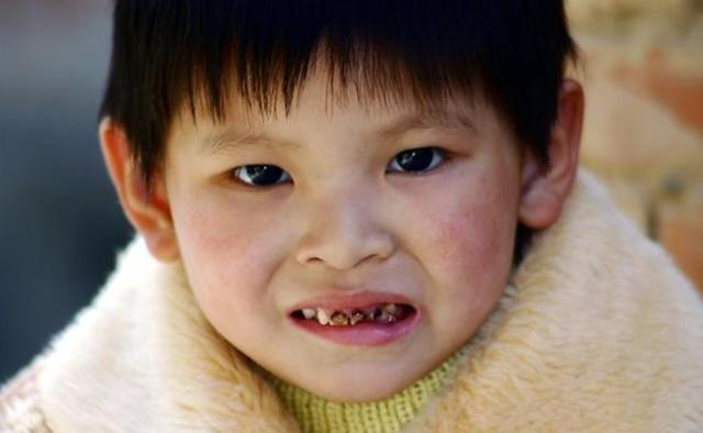 小孩满口蛀牙怎么办,儿童吃什么造成蛀牙