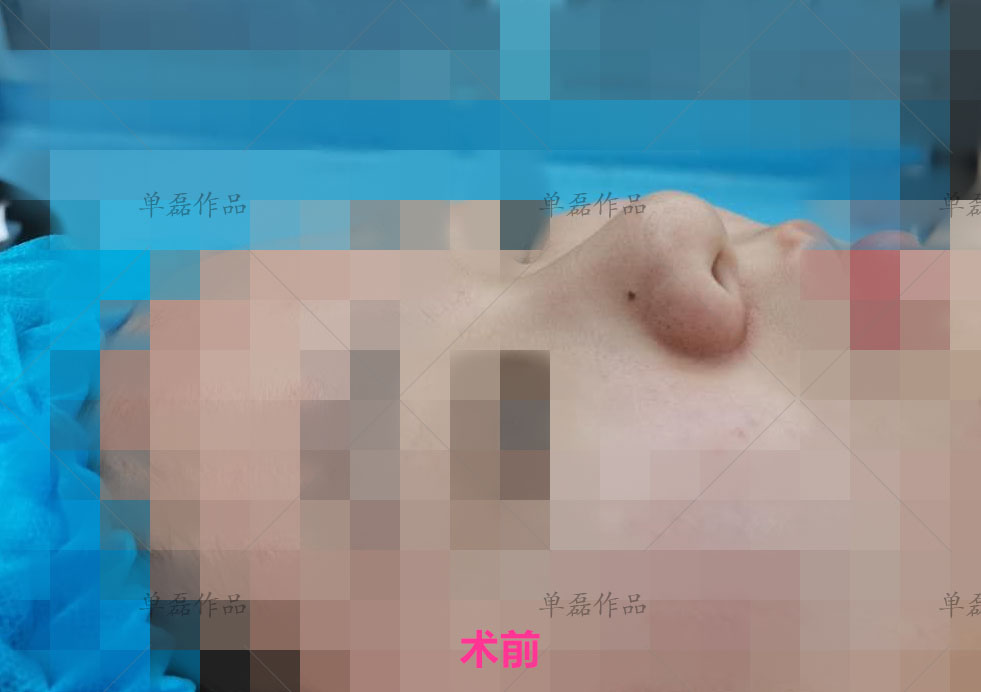 膨体隆鼻科普及优势介绍,膨体隆鼻和肋骨哪个更好