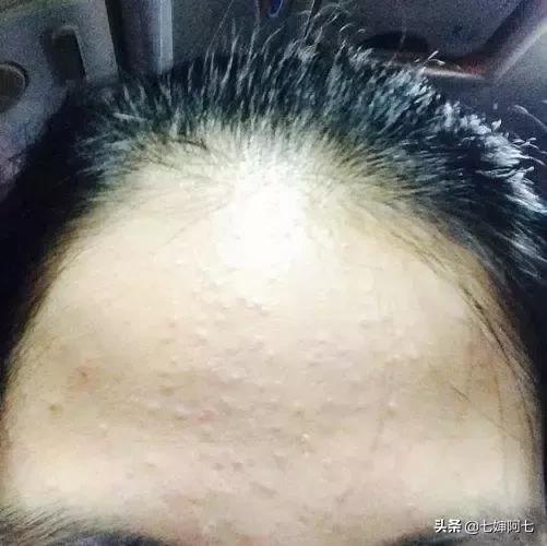 去闭口的正确方法,去闭口痘痘的最佳方法