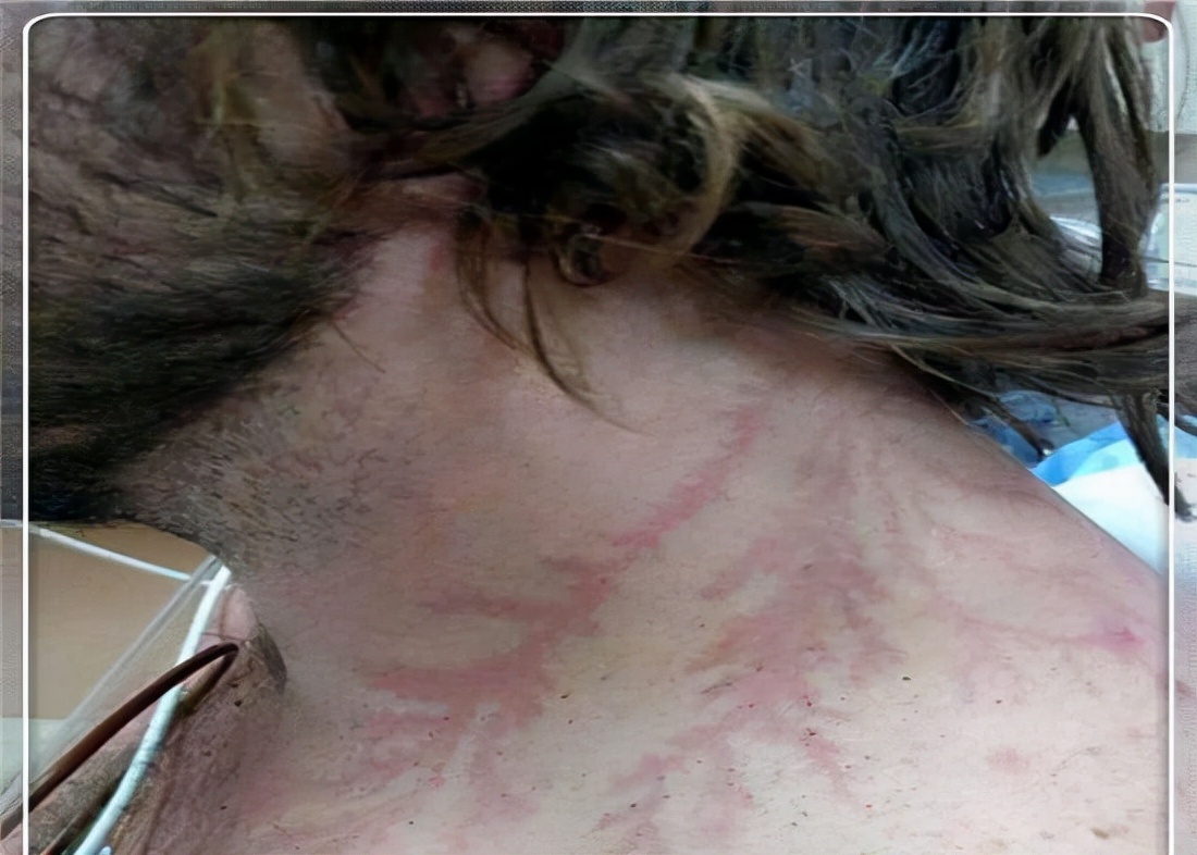 人被雷劈中会发生什么,人被雷劈过后会怎么样