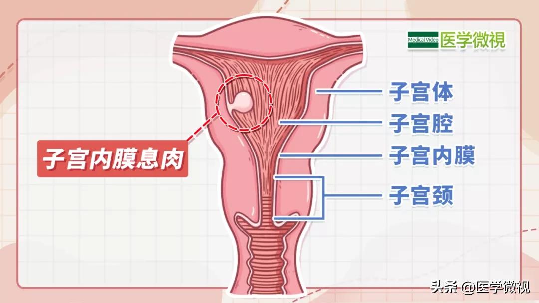 子宫内膜息肉什么情况下会癌变,子宫内膜息肉会癌变吗