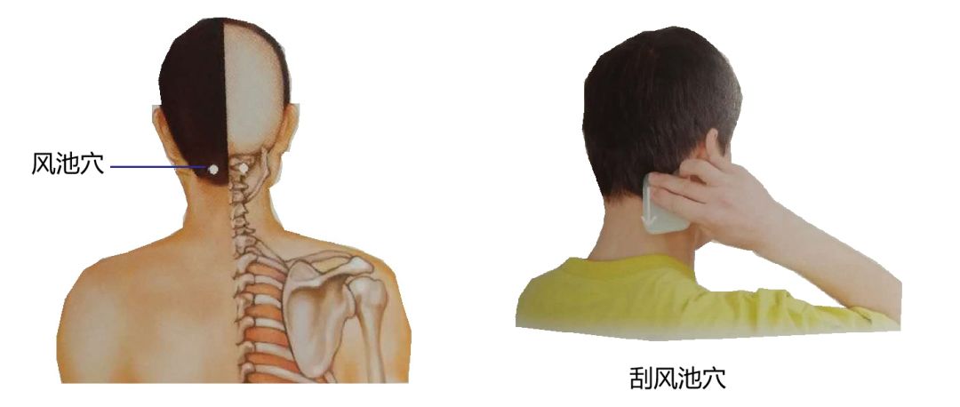 头痛刮痧后就不痛了是什么原因,感冒头痛刮痧快速缓解