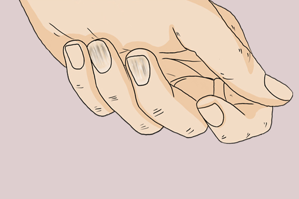 指甲有竖条纹肝脏不好,指甲竖条纹肝脏