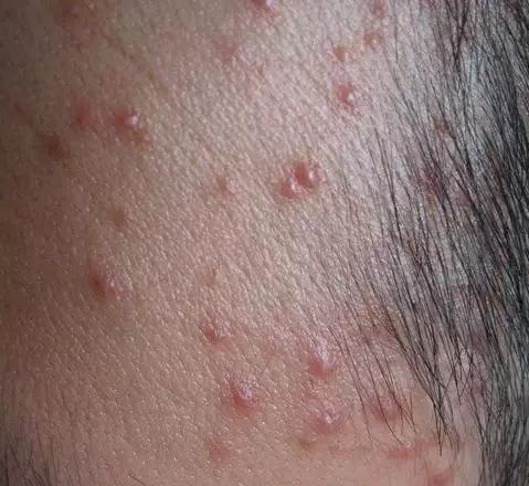 前胸后背的痘痘去不掉怎么办,前胸后背胳膊反复长痘痘该怎么办