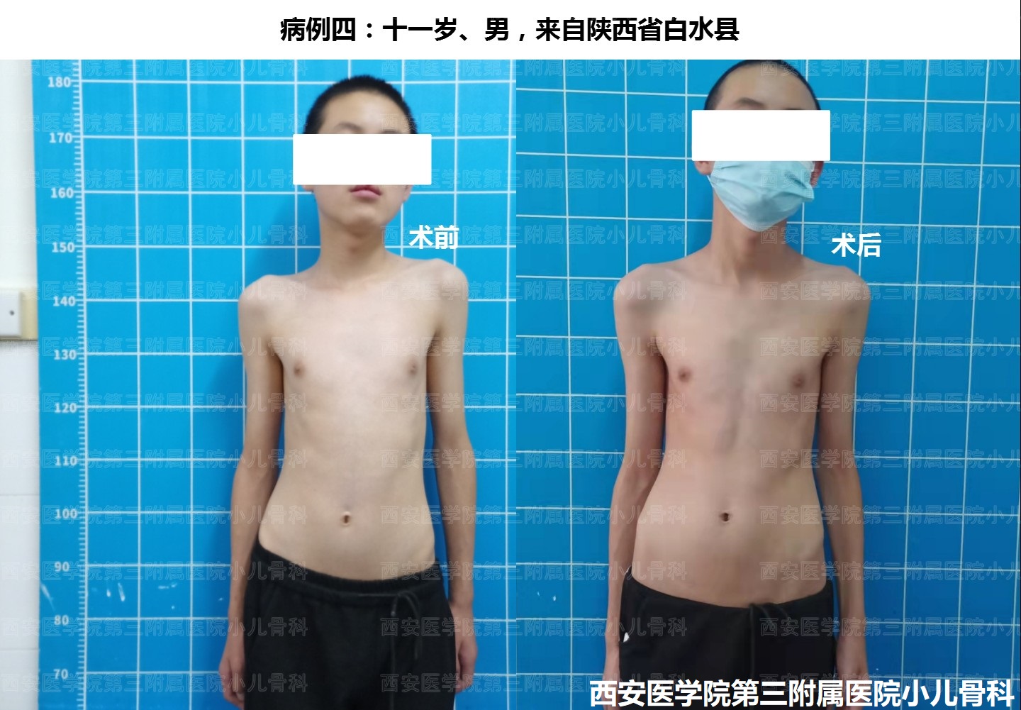 先天性高肩胛手术,先天性肩胛症通过手术需要多少钱