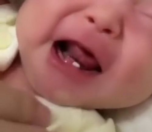 新生儿诞生牙案例,婴儿出生时已萌出的牙齿