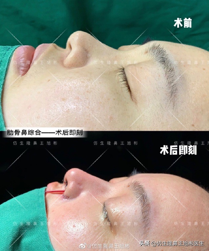 鼻翼整形矫正过程,鼻整形鼻尖下垂怎么办