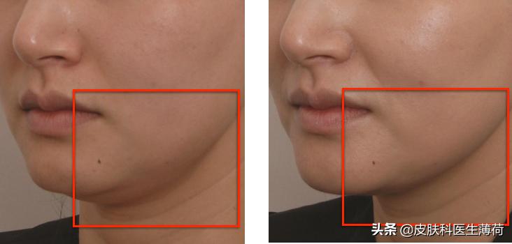 激光点阵祛痘坑收缩毛孔仪器,皮秒激光祛雀斑效果图