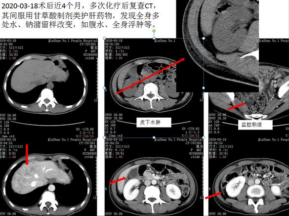 咳嗽药是不是容易伤肝,止咳药会成瘾吗