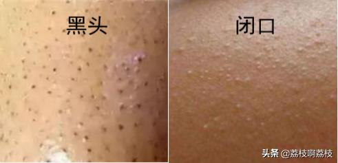 为什么痘痘总是长在同一位置上,同一个位置反复长痘痘怎么治