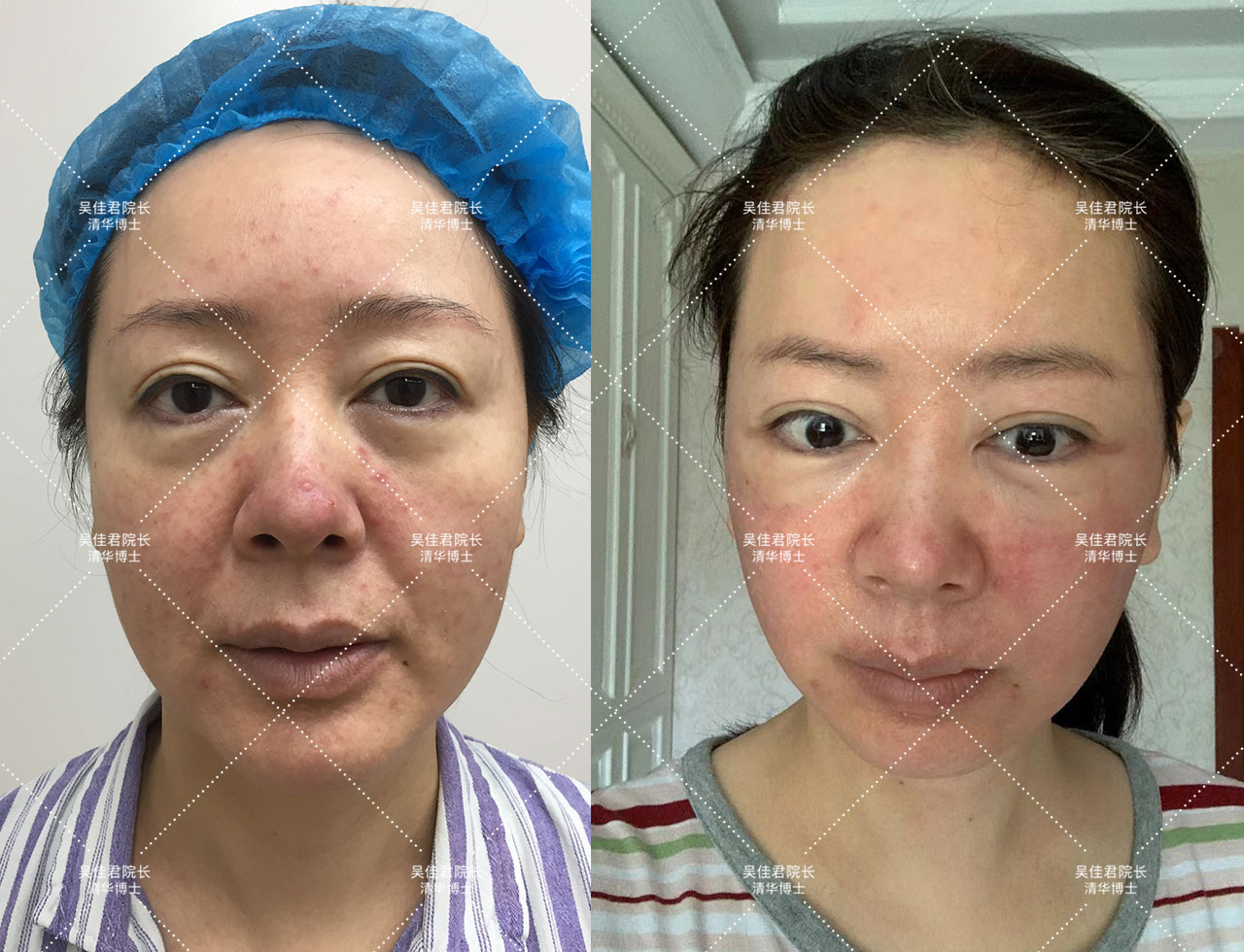 54岁姐姐分享大拉皮术后恢复历程,48岁做拉皮手术的真实经历