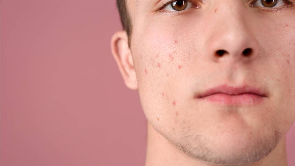 脸上长痘化脓有什么好办法,脸上化脓的痘痘去除最快方法