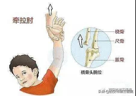 【爱不慌神】大手拉小手，当心“牵拉肘”