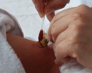 关于新生儿肚脐的护理,新生儿脐部问题