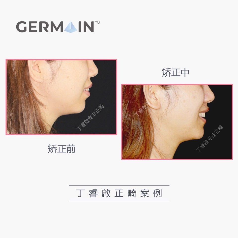 郑州牙齿矫正丁睿啟｜下巴后缩病例合集