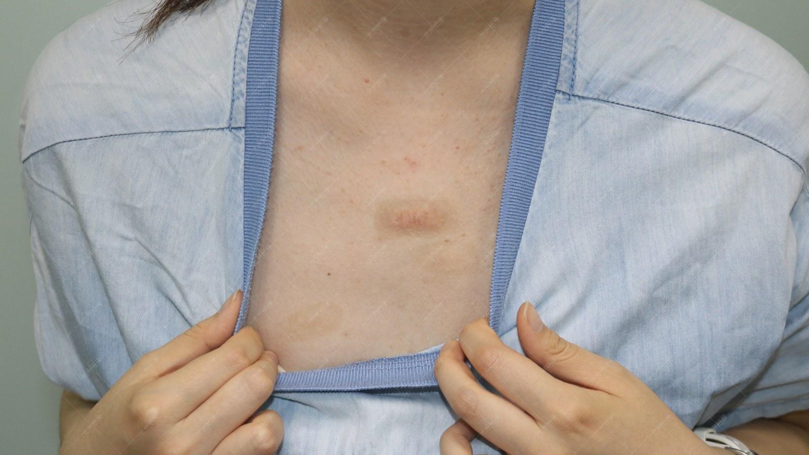 疤康医院治疗疤痕大概多少钱,祛疤灵能去除疤痕吗