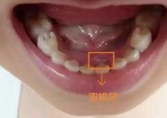 双排牙乳牙松动了还需要拔吗,一岁半宝宝长双排牙要拔吗