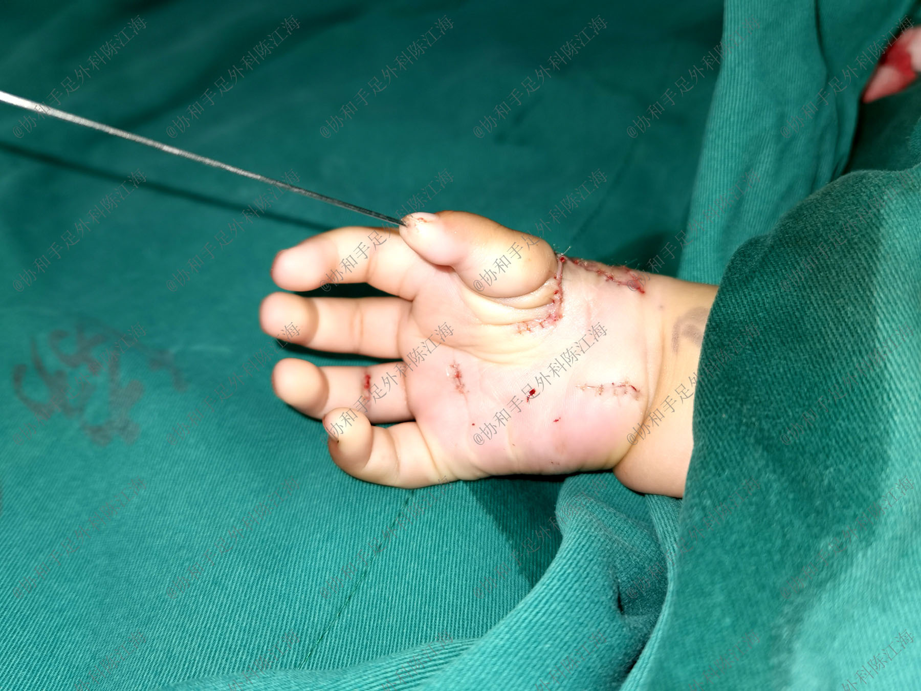 婴儿怎么看手指发育情况,宝宝手指多指是什么原因造成的