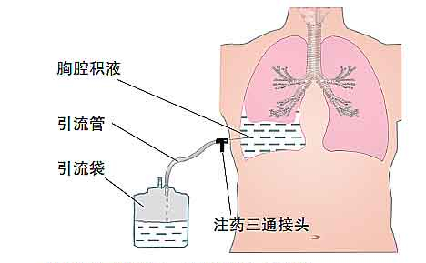 胸腔积液能抽干净吗,胸腔积液能随意抽吗