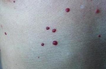 身上长血痣怎么按摩调理,身上长血痣什么原因