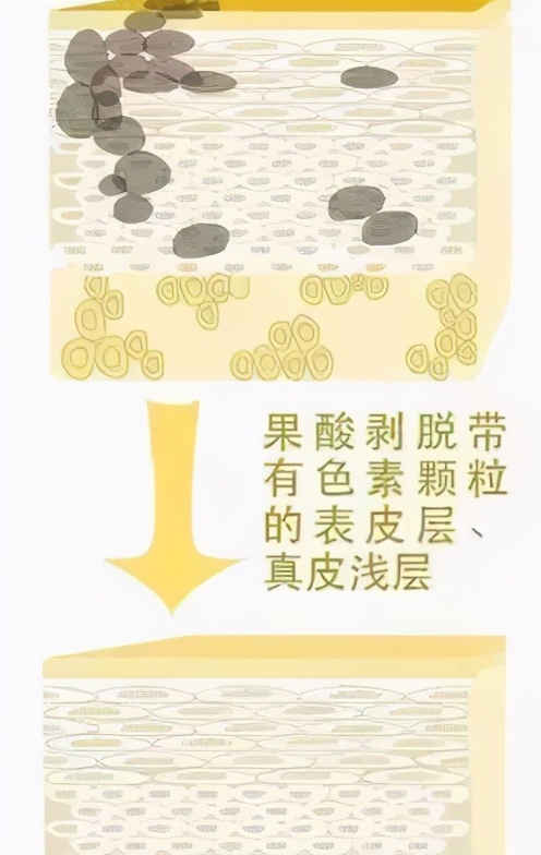 痘肌必看果酸换肤详细指南,果酸换肤对治疗痘痘作用大吗