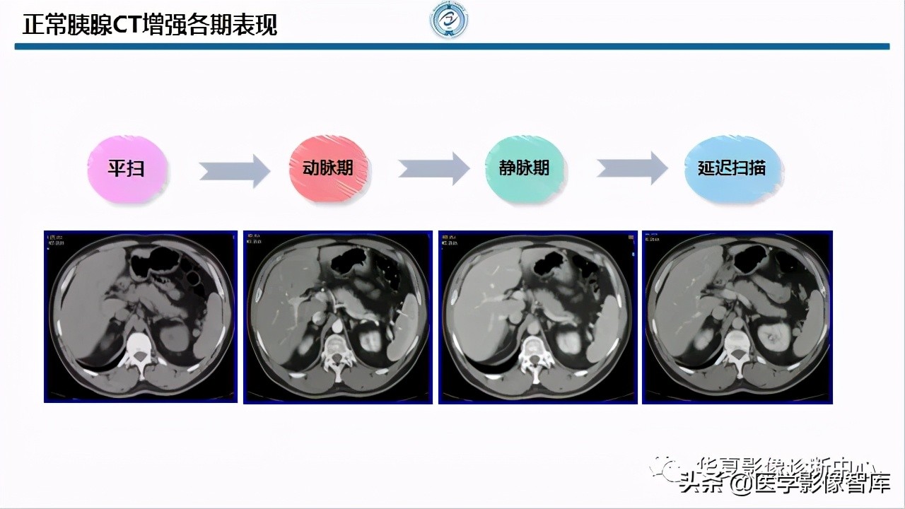 核磁ct都显示急性胰腺炎,急性坏死性胰腺炎的ct表现