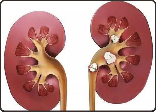 痛风性肾病该如何保养？痛风怎样预防？
