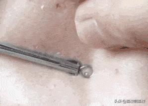 挤完黑头一个洞洞怎么处理解压,挤完黑头留下的洞洞怎么办