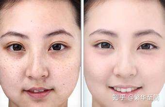 什么药膏能消除脸上的色斑,过敏后脸上的色斑怎么快速消除