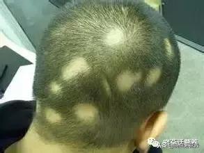 斑秃饮食食谱一览表,斑秃须注意饮食调理