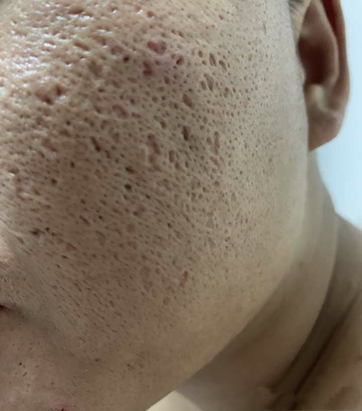 油皮毛孔粗大毛孔多要怎么改善,油皮毛孔粗大护肤品